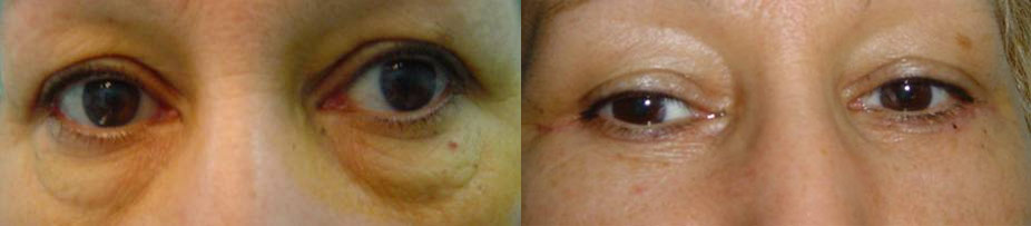 Blépharoplastie Inférieure Avant Après