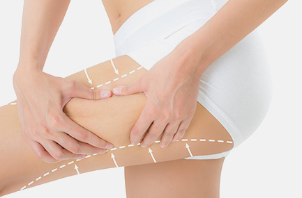 Schéma Lifting Cuisses 1