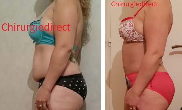 Liposuccion Hanches Avant Après