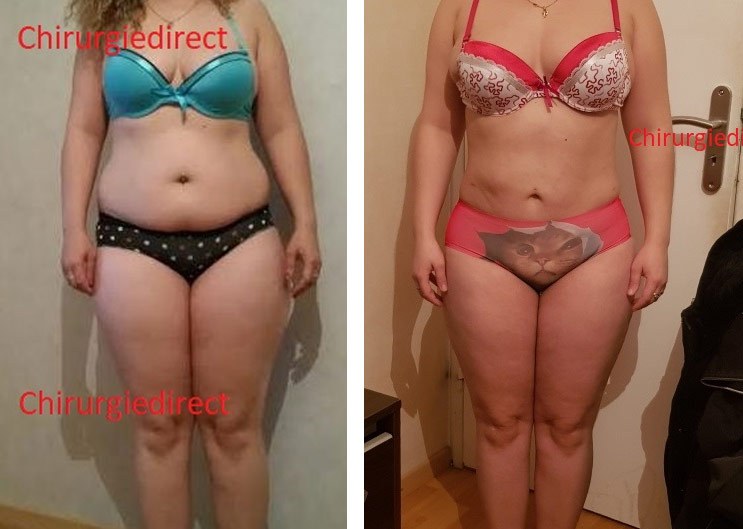 Liposuccion Ventre Avant Après