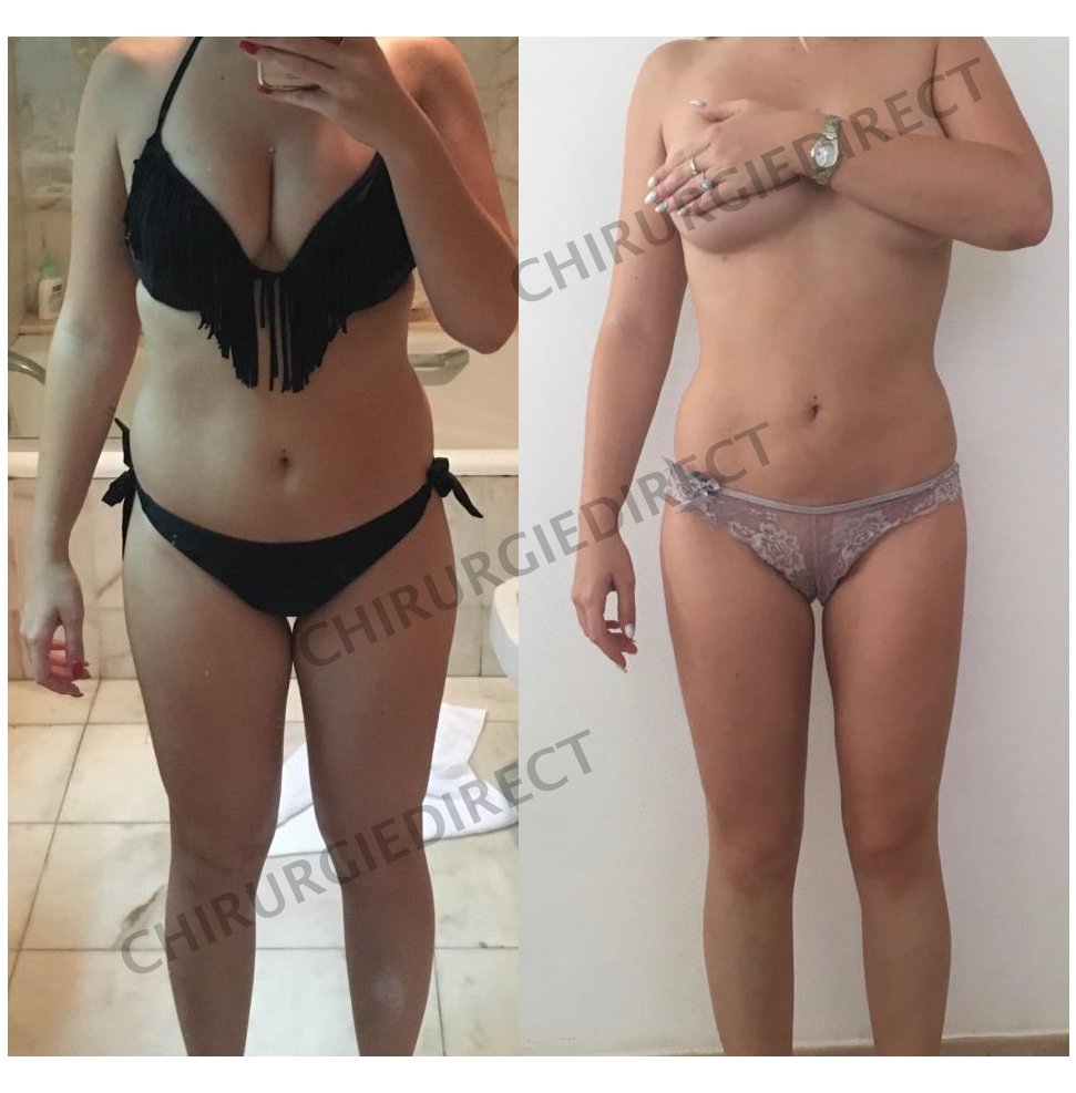 Liposuccion Profil Avant Après