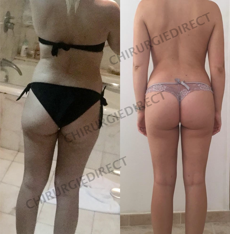 Liposuccion Dos Avant Après