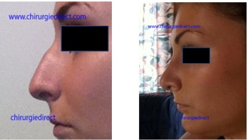 Résultat Rhinoplastie Avant Après