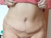 Abdominoplastie Après