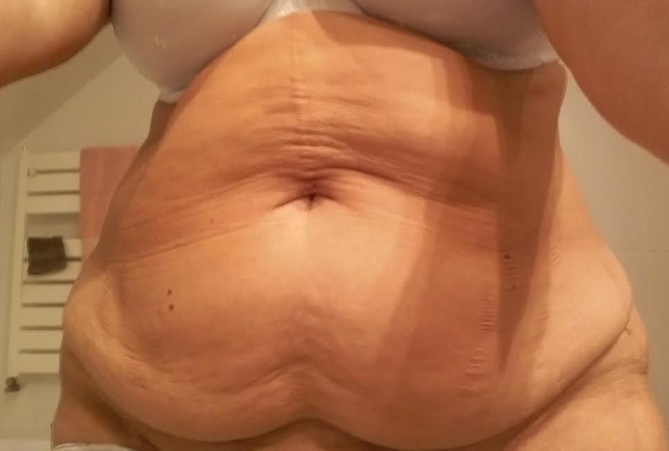 Abdominoplastie Avant
