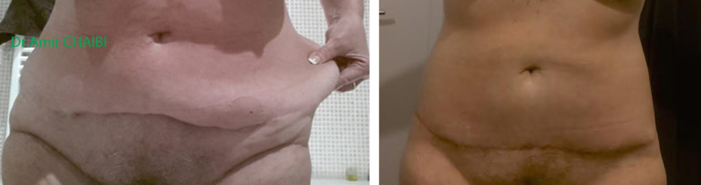 Bodylift Avant Après 2 mois