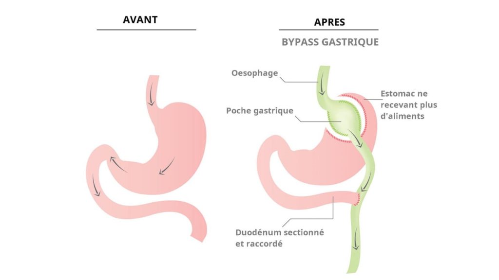 Schéma Bypass Gastrique