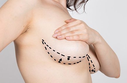 Schéma Augmentation Mammaire tunisie