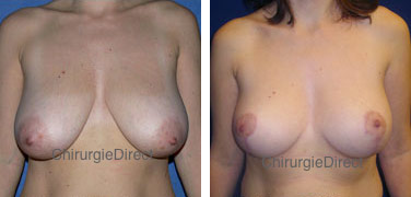 Résultat Lifting Seins