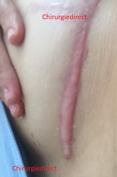 Exemple Cicatrice Chéloïde