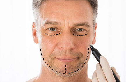 Schéma Génioplastie 1