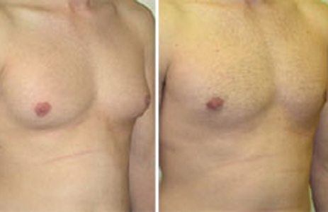 Gynécomastie Avant Après 2