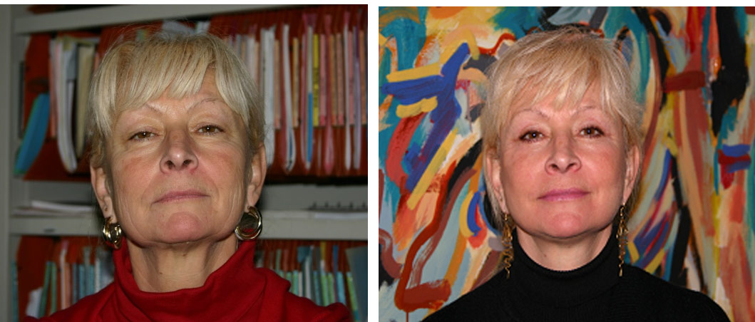 Résultat Lifting Cervico Facial