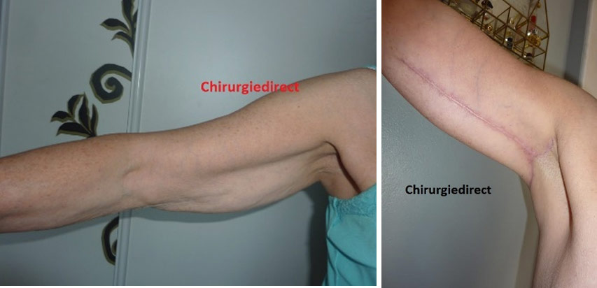 Photo Avant Après Lifting Bras