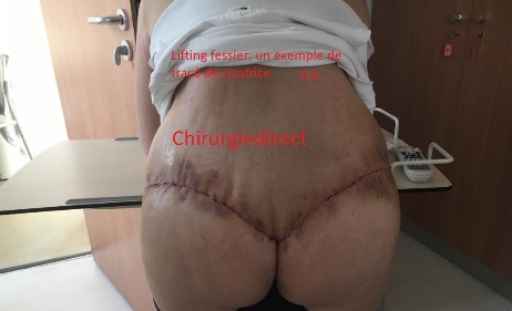 Cicatrice Lifting Fessier