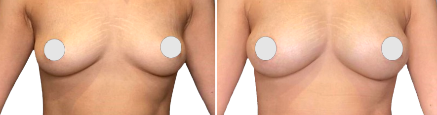 Lipofilling Seins Avant Après