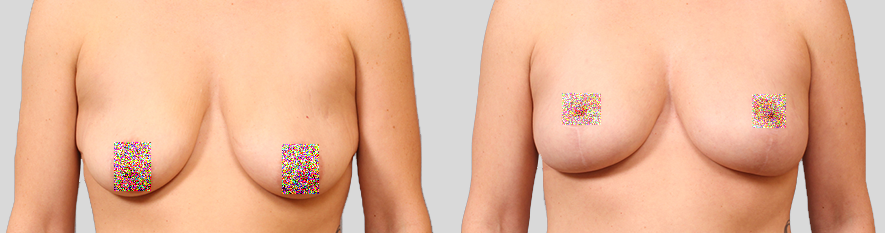 Résultat Lipofilling Mammaire