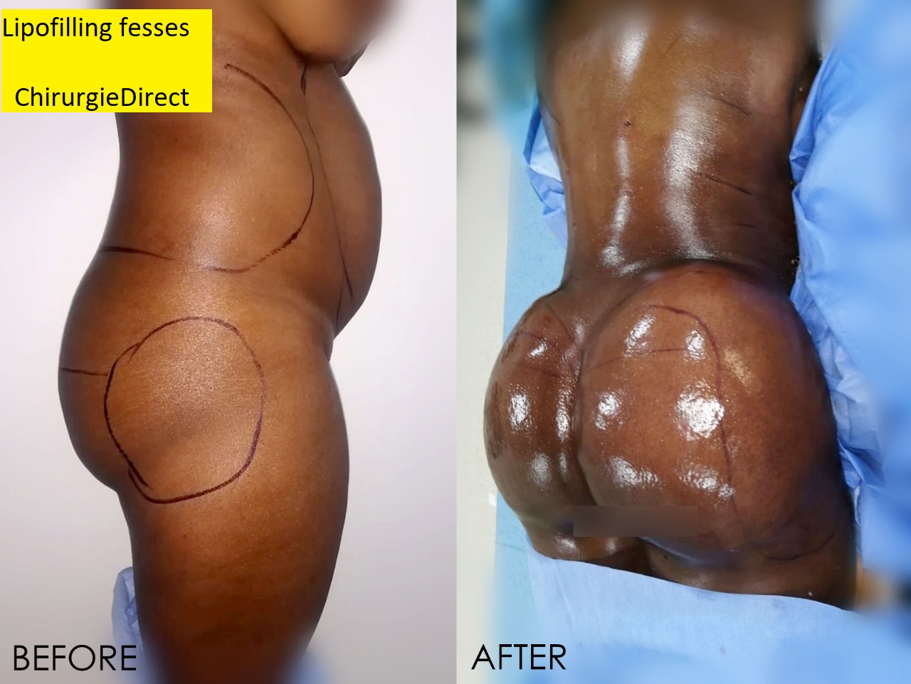 Lipofilling fesses Avant Après Profil