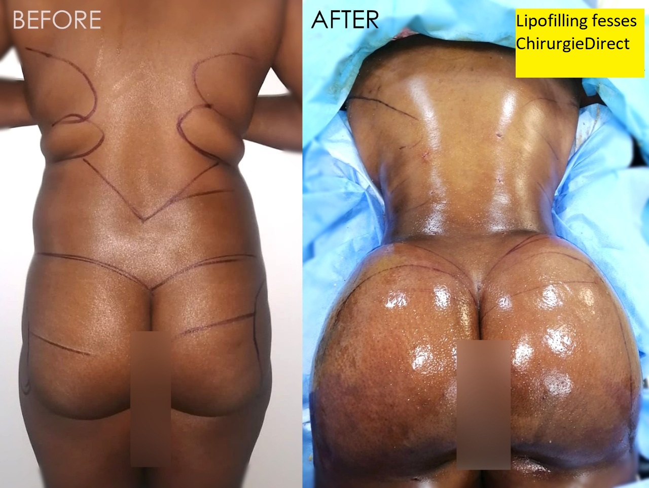 Lipofilling fesses Avant Après Dos