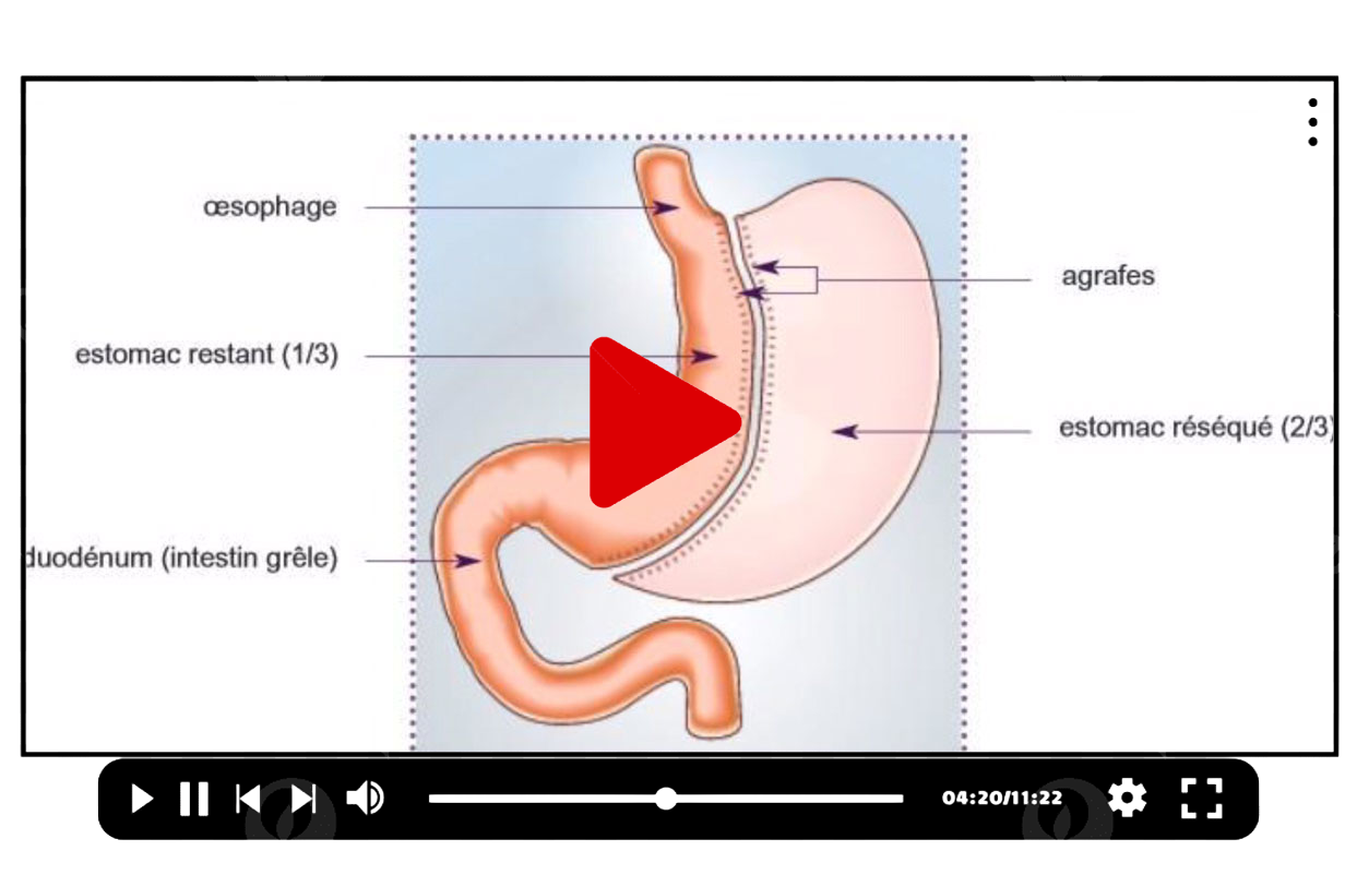 Chirurgie ob&eacute;sit&eacute; Tunisie